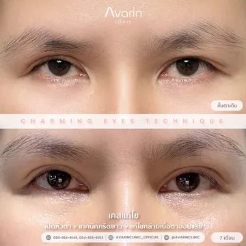 B&A-ออม-7เดือน