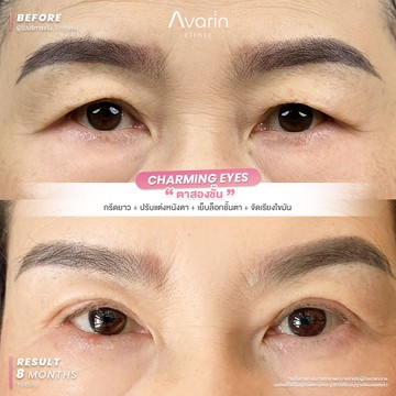หนังตาเยอะ-ตาตกบังการมองเห็น