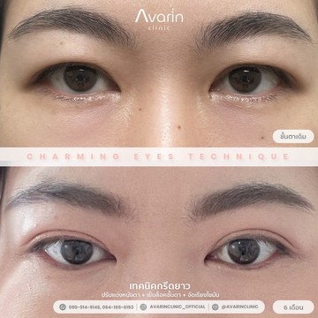 B&A-อ้อม-6เดือน