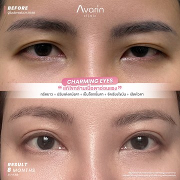 B&A-อ้อม-8เดือน