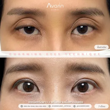B&A-เกด
