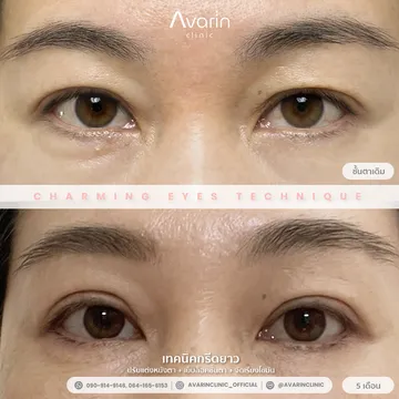 B&A-เจ-5เดือน