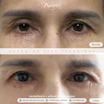 B&A-เจี๊ยบ-1เดือน
