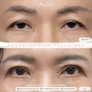 B&A-เล็ก-1ปี
