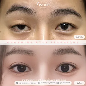 B&A-เล็ก-5เดือน