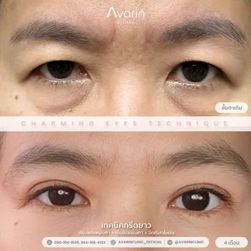 B&A-เอ-4เดือน