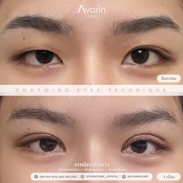 B&A-แก้ม-ตัด