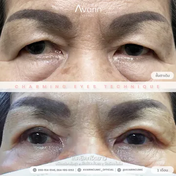 B&A-แจ๊ว-1เดือน