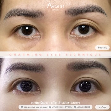 B&A-แต้ว-6เดือน