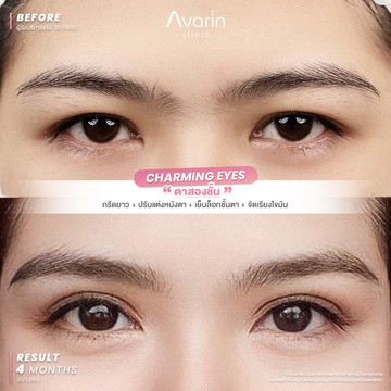 ชั้นตาหลบใน-หนังตาตก-ตาไม่หวาน