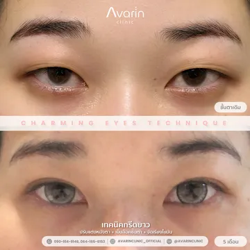 B&A-ไข่มุก-5เดือน