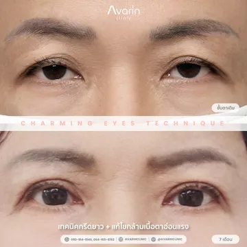 B&A