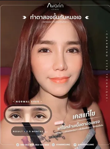 LINEALBUMCaseแก้แก้กล้าม25050110