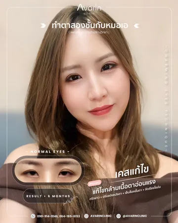 LINEALBUMCaseแก้แก้กล้าม2505011
