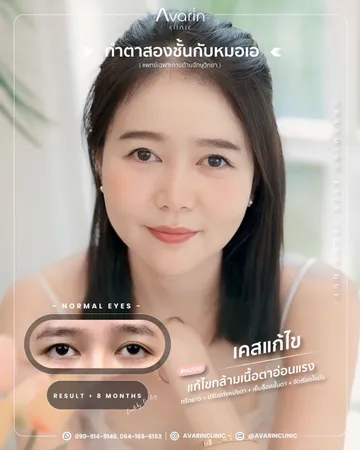 LINEALBUMCaseแก้แก้กล้าม2505012