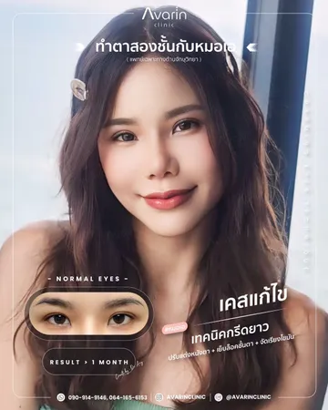 LINEALBUMCaseแก้แก้กล้าม2505014