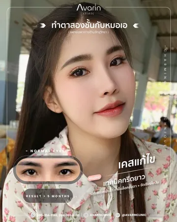 LINEALBUMCaseแก้แก้กล้าม2505015