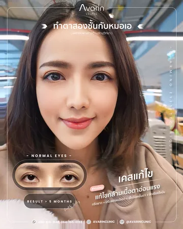 คุณตาลแก้แก้กล้าม2505015