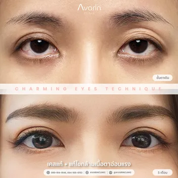 คุณตาลแก้แก้กล้าม6เดือน