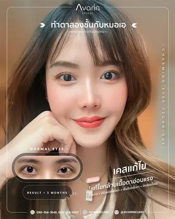 งานแก้ไขตาสองชั้นที่เคยทำมาก่อน(1)
