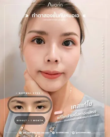 งานแก้ไขตาสองชั้นที่เคยทำมาก่อน(2)
