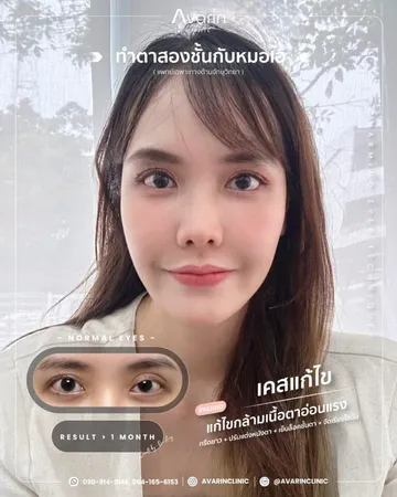 งานแก้ไขตาสองชั้นที่เคยทำมาก่อน(3)