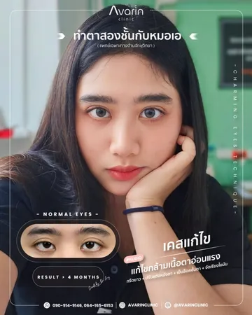 งานแก้ไขตาสองชั้นที่เคยทำมาก่อน(4)