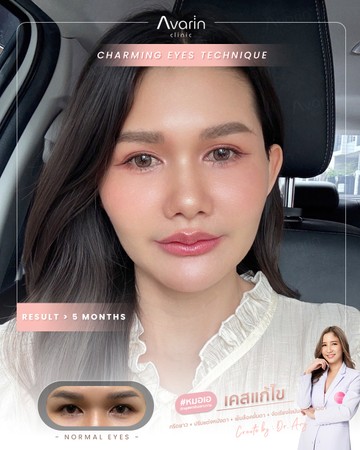 นุ่น-แก้ตัด-5เดือน