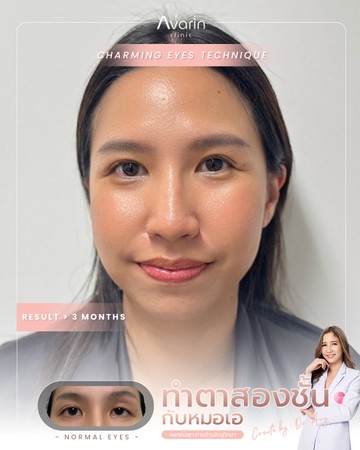 หน้าเต็ม-ฟิว-3เดือน