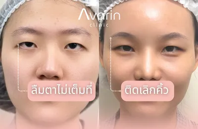 ก่อนทำ