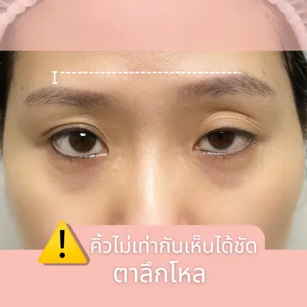 บัดบังการมองเห็น2