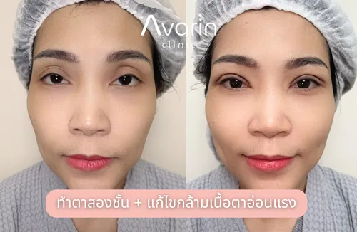 ก่อนทำ(1)