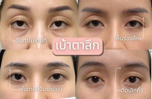 ก่อนทำ