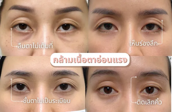 ก่อนทำ(1)