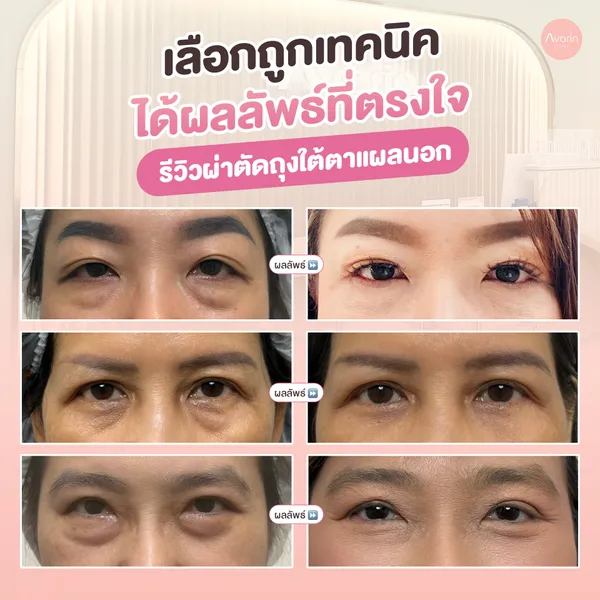 ผลลัพธ์-แผลนอก
