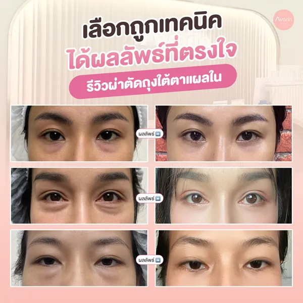 ผลลัพธ์-ใน