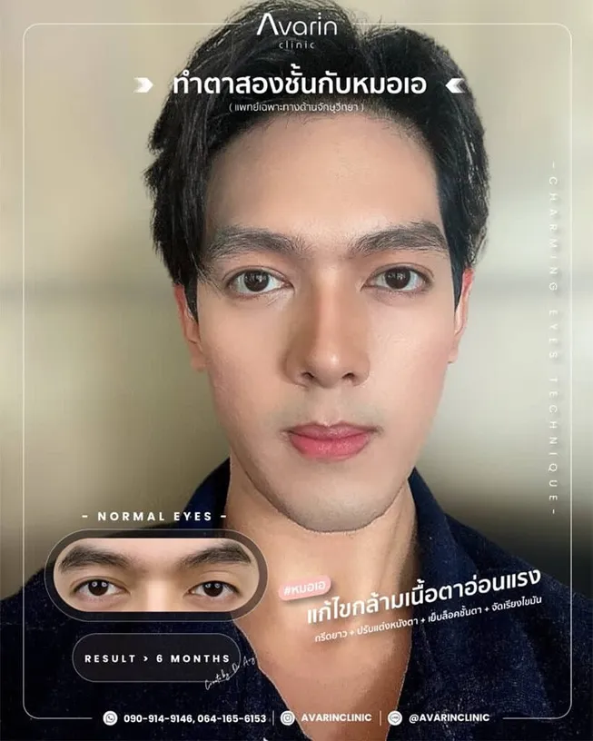 การทำตาสองชั้นในผู้ชาย31643352802666
