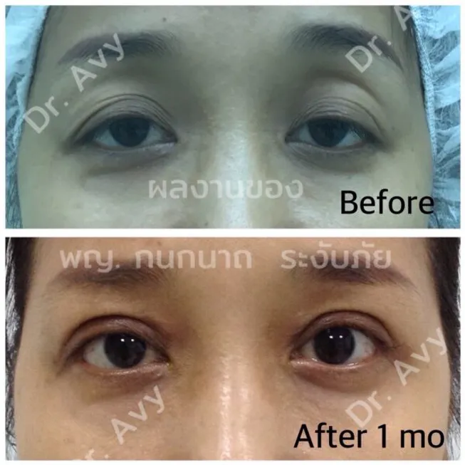 ตาอ่อนแรง-600x600