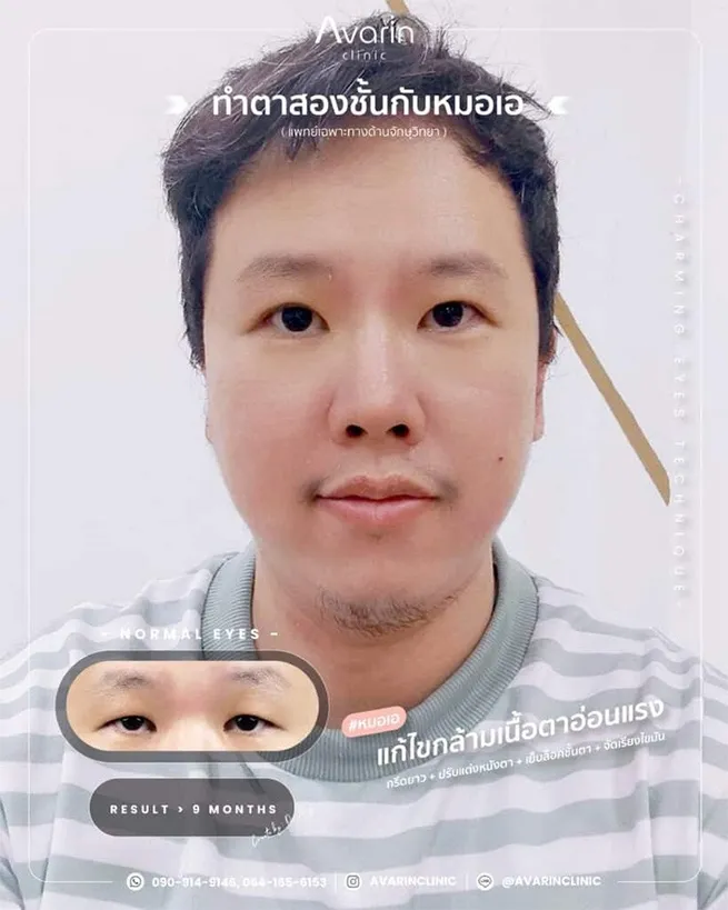 การทำตาสองชั้นในผู้ชาย4637586988733