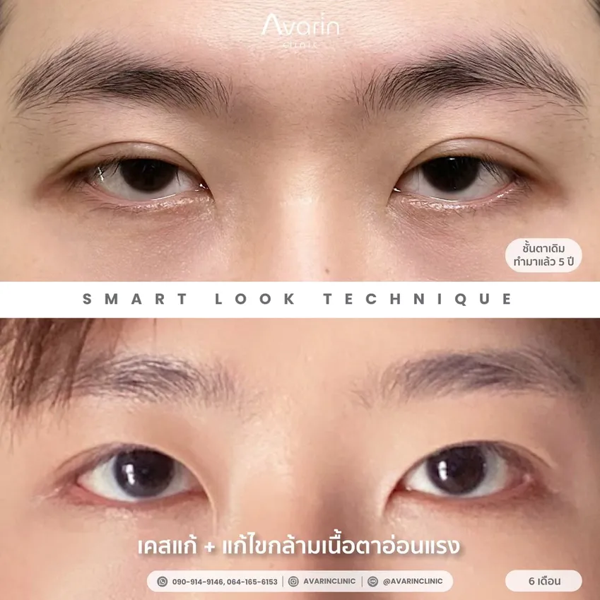 LINEALBUMแก้กล้าม-ผู้ชาย2504235