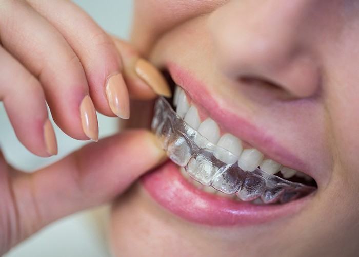 จัดฟันใส-Invisalign3