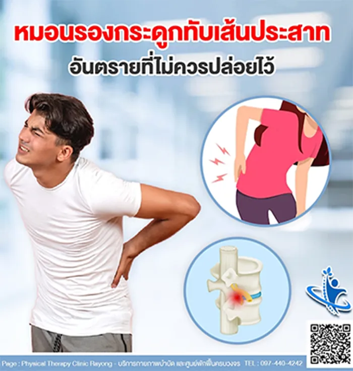 หมอนรองกระดูกทับเส้นประสาท