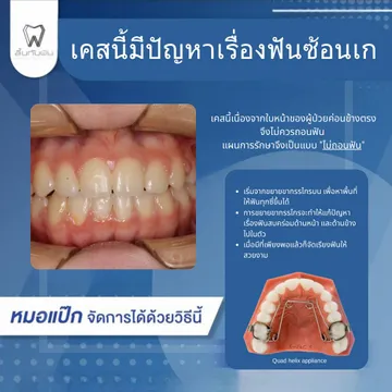 44257410