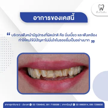 รีวิวทำวีเนียร์2