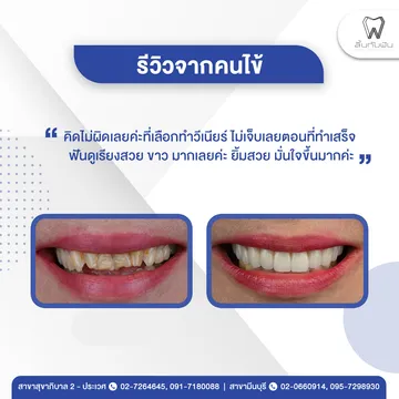 รีวิววีเนียร์1