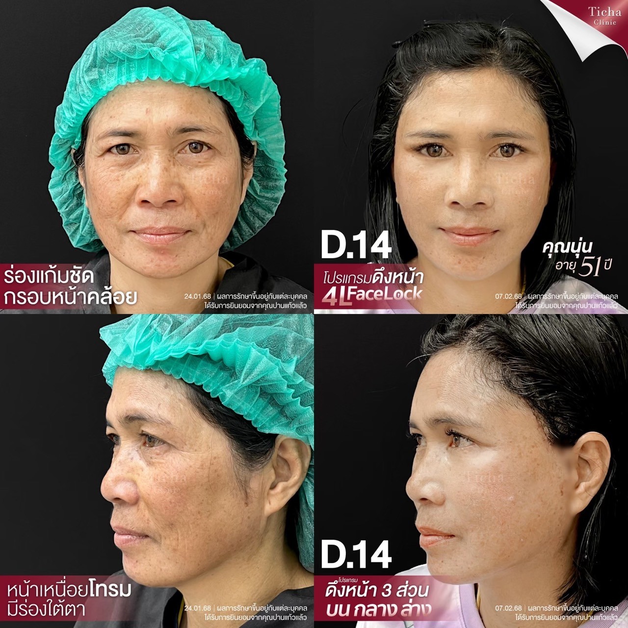 ทำไมต้องเลือกมาดึงหน้าที่TichaClinic(2)
