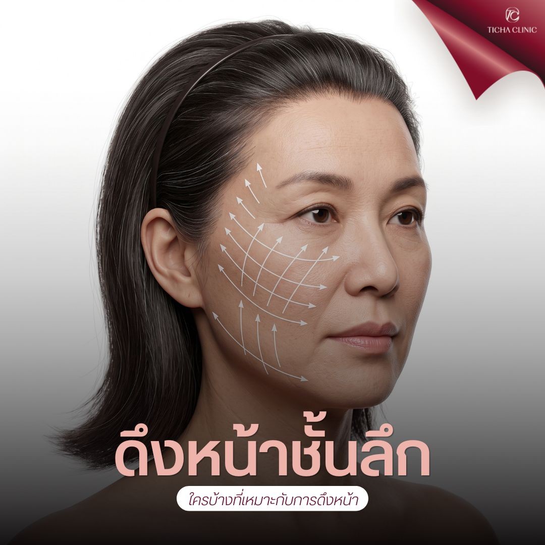 15.3 TC _ หน้าหย่อนคล้อยจากกรรมพันธุ์หรืออายุ_ ดึงหน้า SMAS เทคนิคดั้งเดิมช่วยตอบโจทย์โครงหน้าคนเอเชียอย่างไร