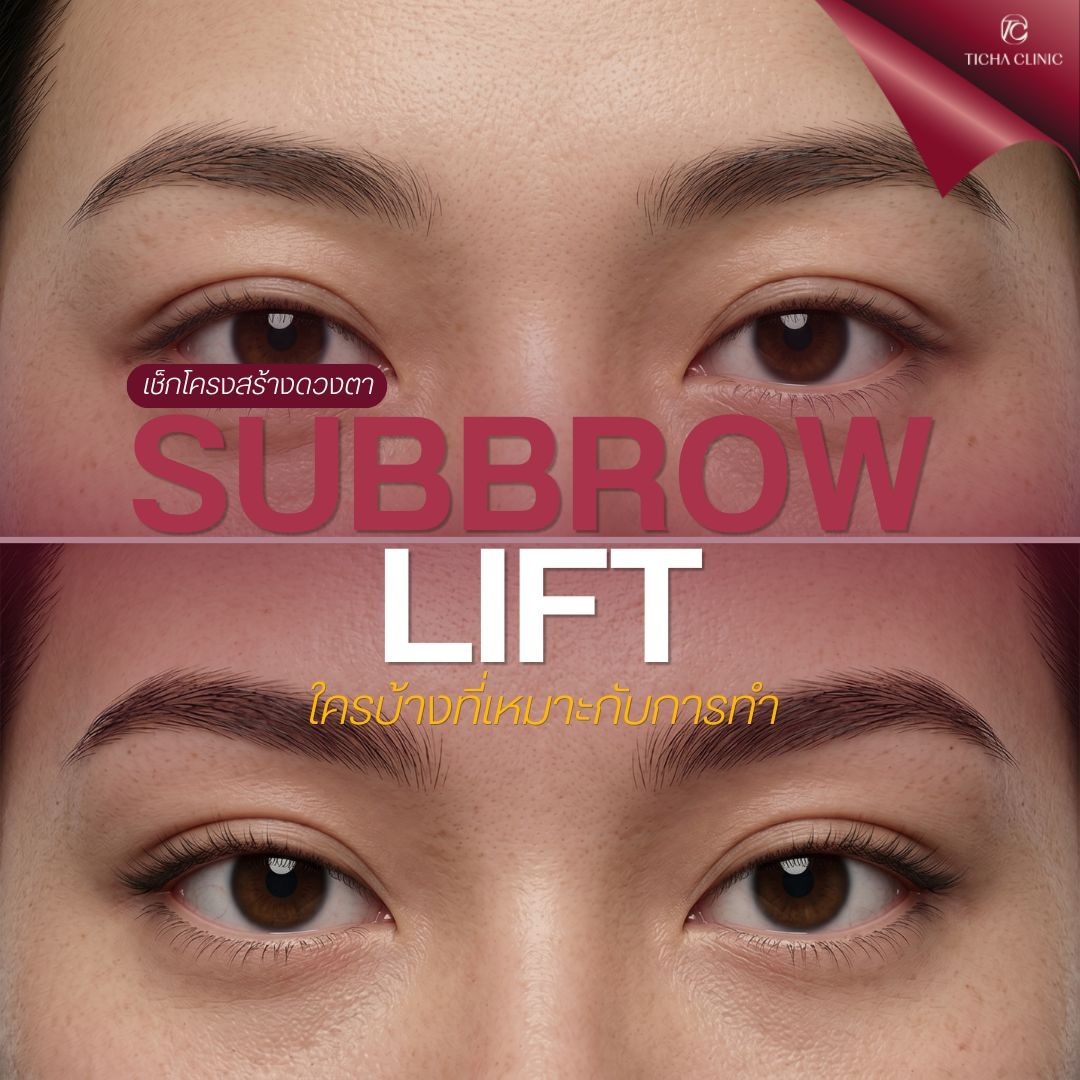 16.2 TC _ ใครบ้างที่เหมาะกับ Subbrow Lift_ เช็กโครงสร้างตาและคิ้วก่อนตัดสินใจ