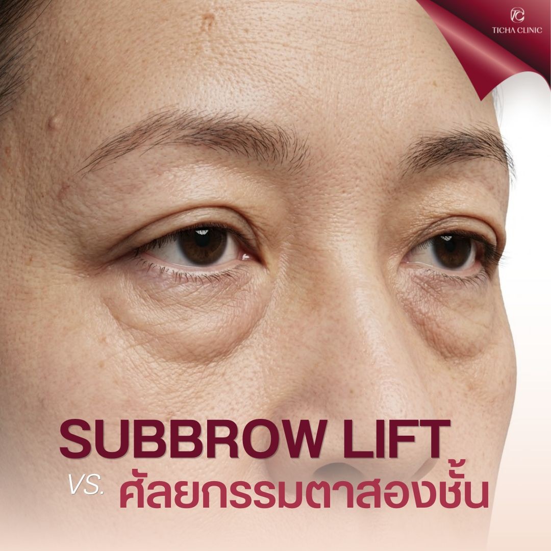 16.3 TC _ ใครบ้างที่เหมาะกับ Subbrow Lift_ เช็กโครงสร้างตาและคิ้วก่อนตัดสินใจ