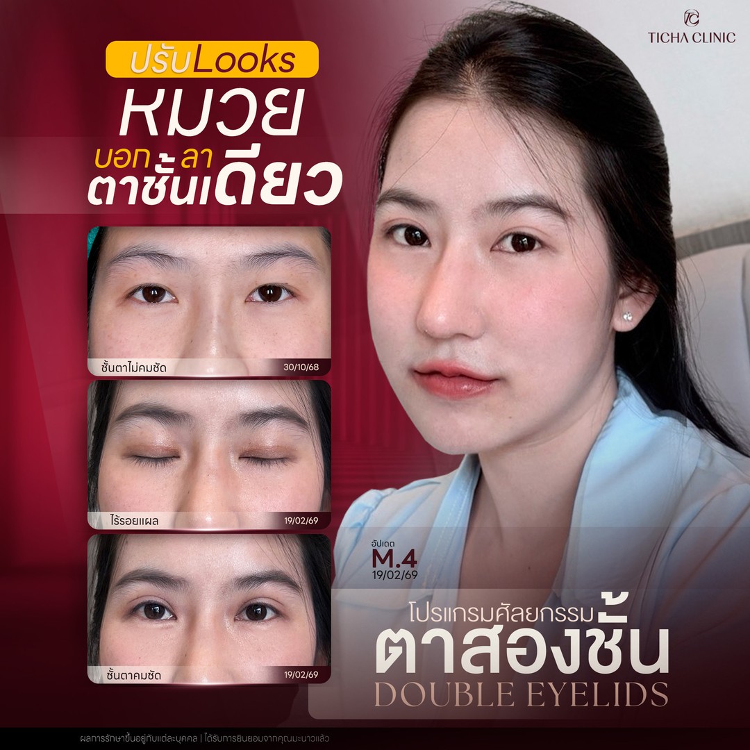 16.4 TC _ ทำตาสองชั้นเทคนิคกรีดสั้น vs กรีดยาว ต่างกันอย่างไร_ ตาแบบเราเหมาะกับเทคนิคไหน_